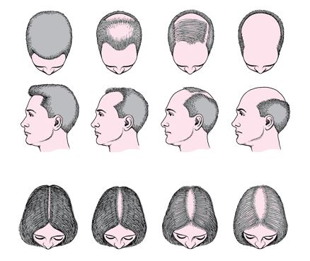 alopecia-androgenetica-queda-de-cabelo-calvice-tratamento